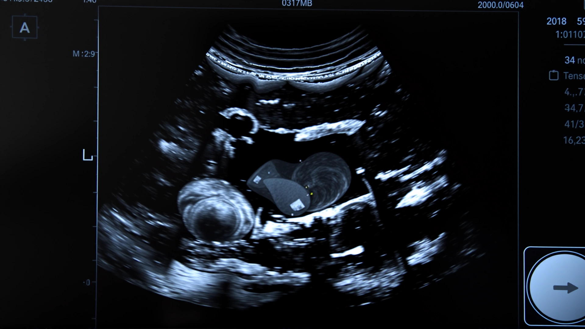 Close-up grayscale ultrasound monitor image showing a feline liver, minimal interface, no visible text or labels